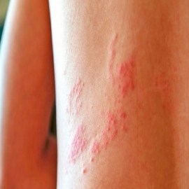 Pretenden disimular el aumento de culebrilla, Herpes Zoster, causado por la inyección Covit